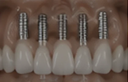Implantología oral