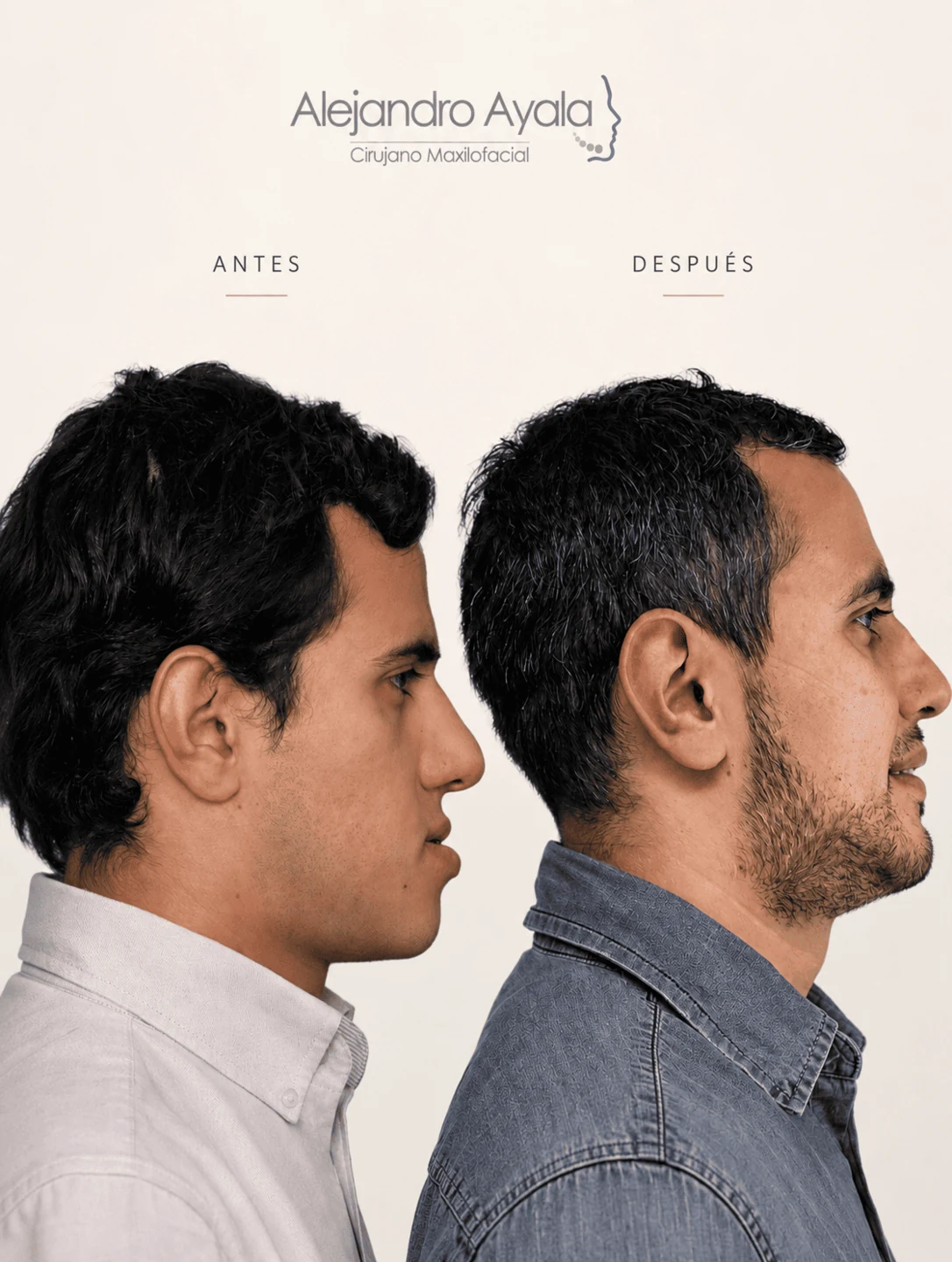 Perfil antes y después de cirugía ortognática bimaxilar