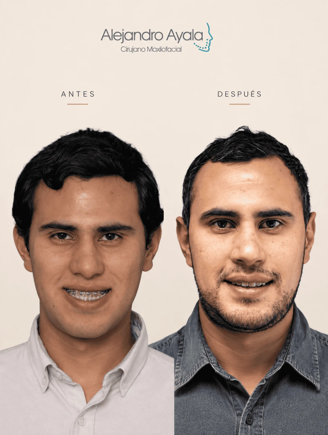 Sonrisa antes y después de cirugía ortognática bimaxilar