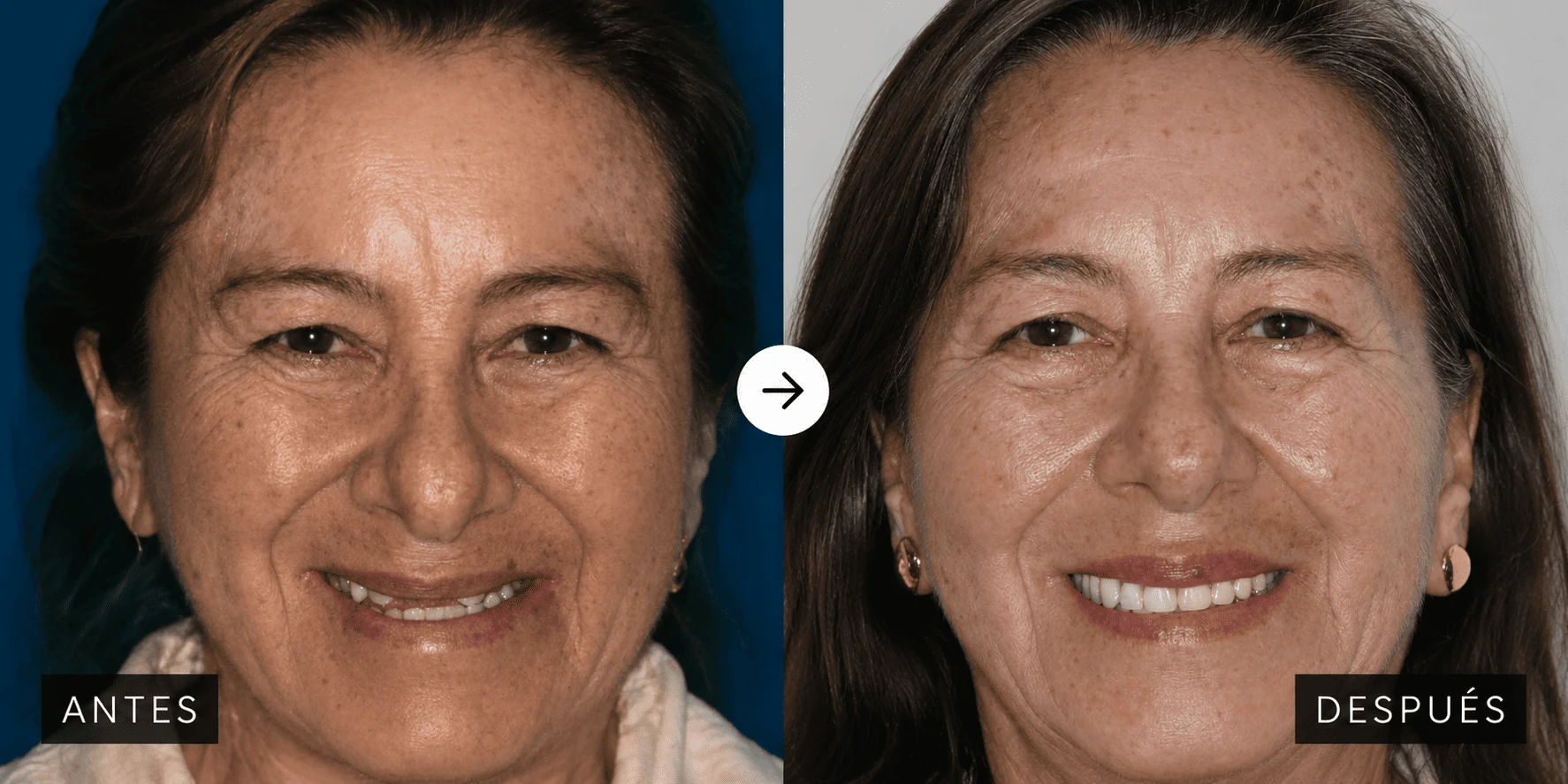 Articulación temporomandibular
