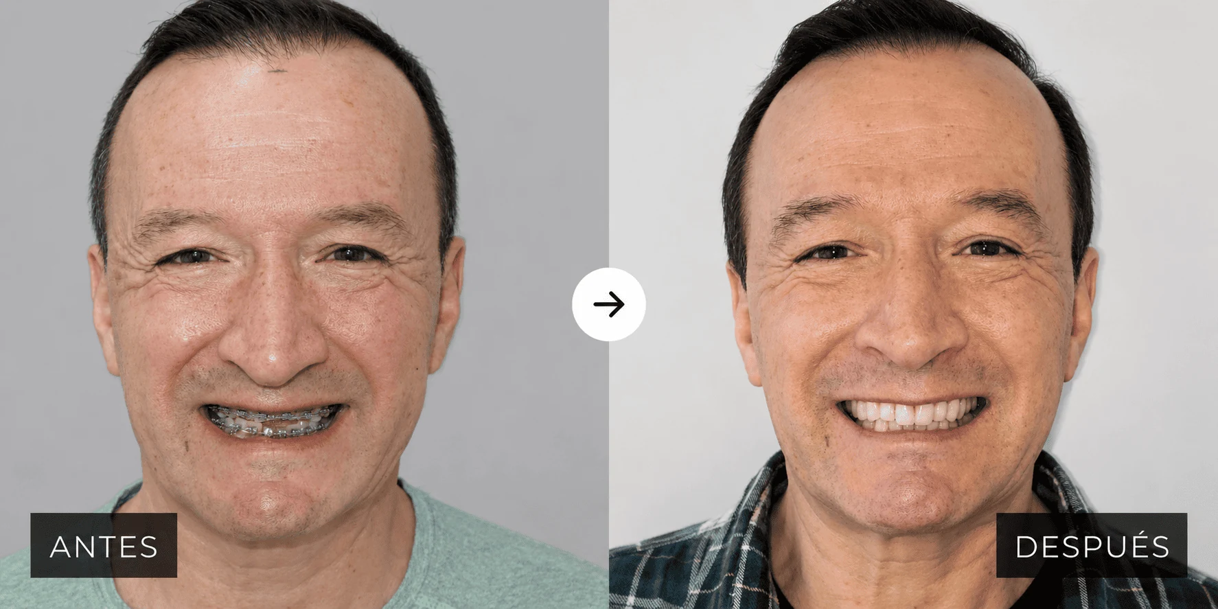 Reconstrucción con implantes